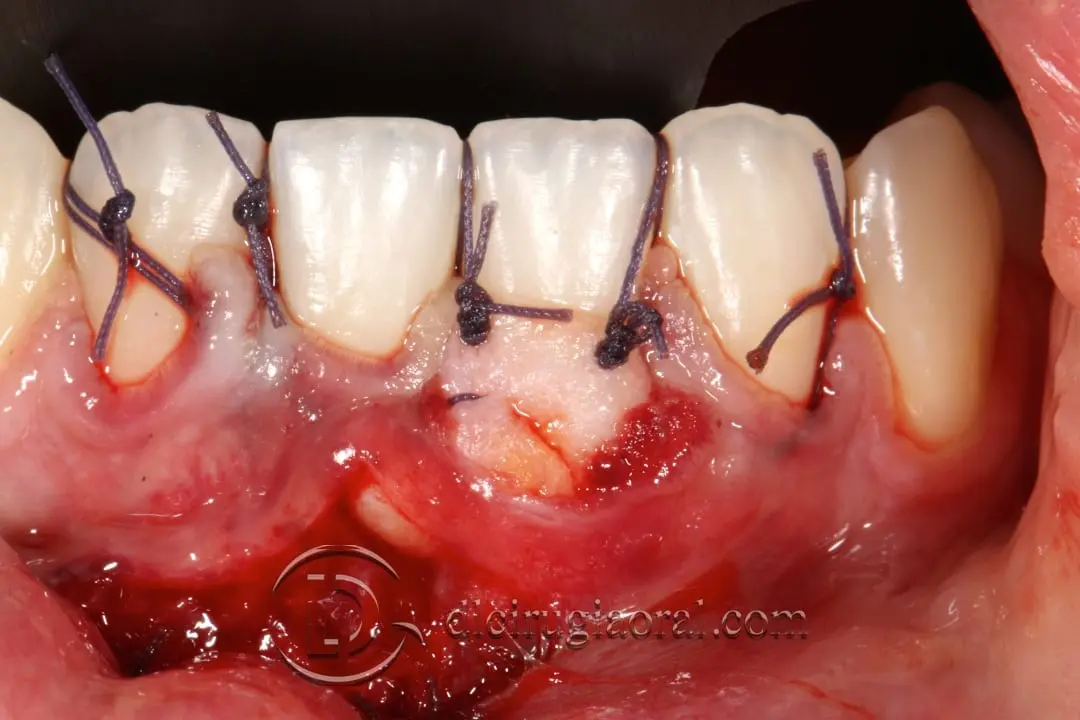 A connective tissue graft sutured over the recessions in the lower front teeth