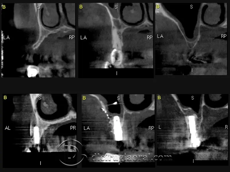 Six CBCT cross-sections used to plan the implant positions