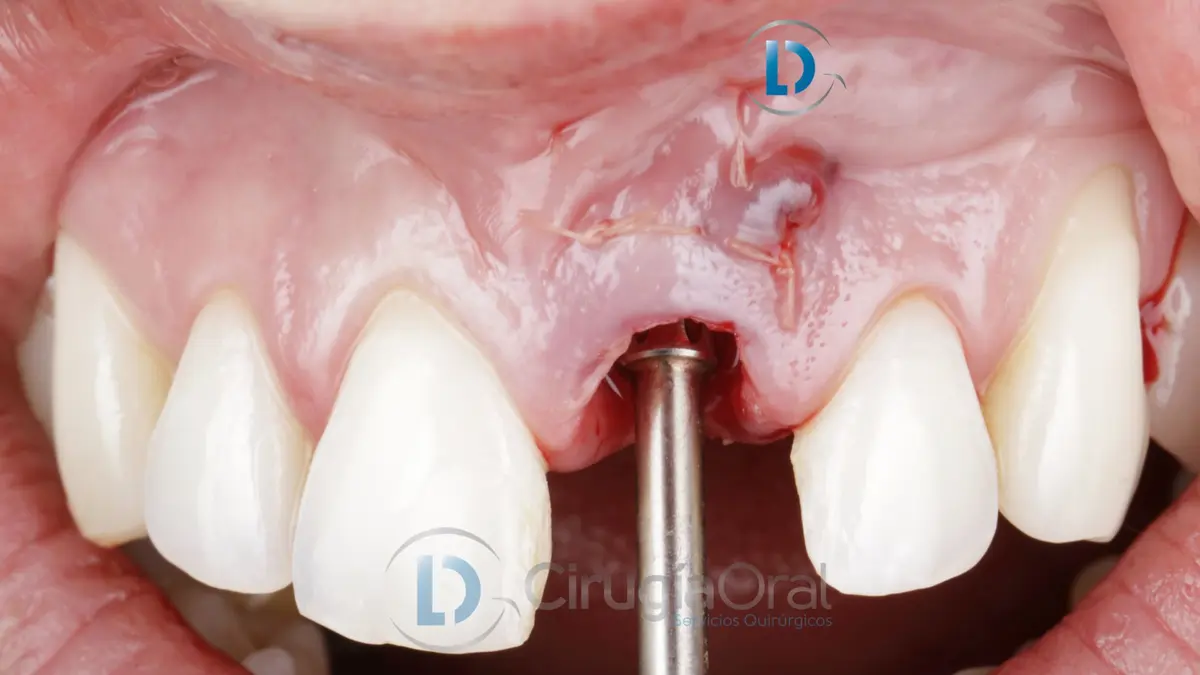 The implant mount in place between the natural teeth, before the provisional crown
