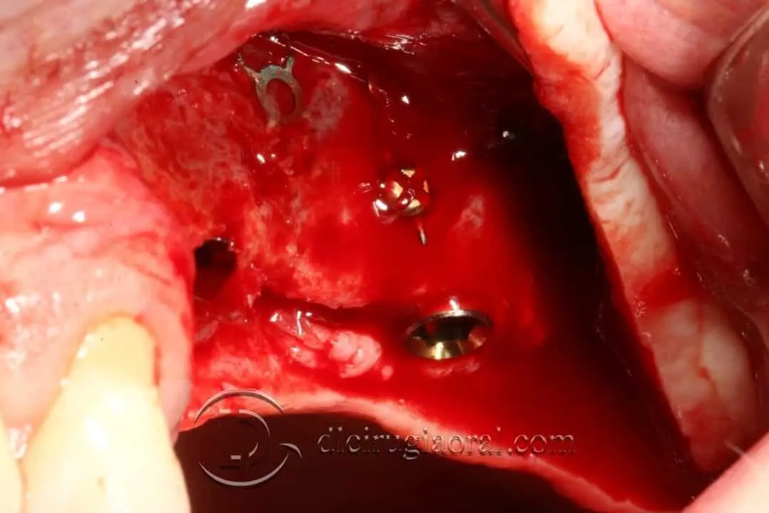 Two implants placed through the open flap in a posterior maxilla