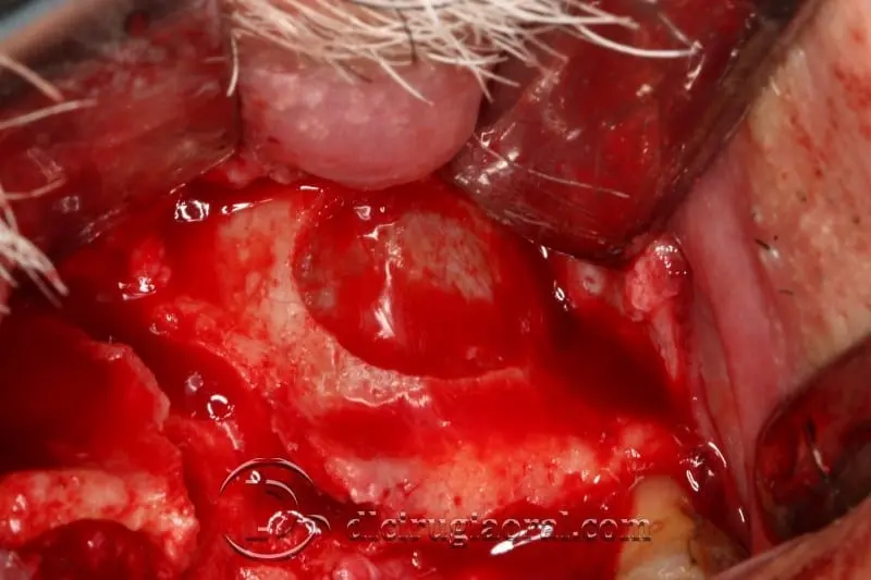 The grafted sinus floor seen through the lateral window