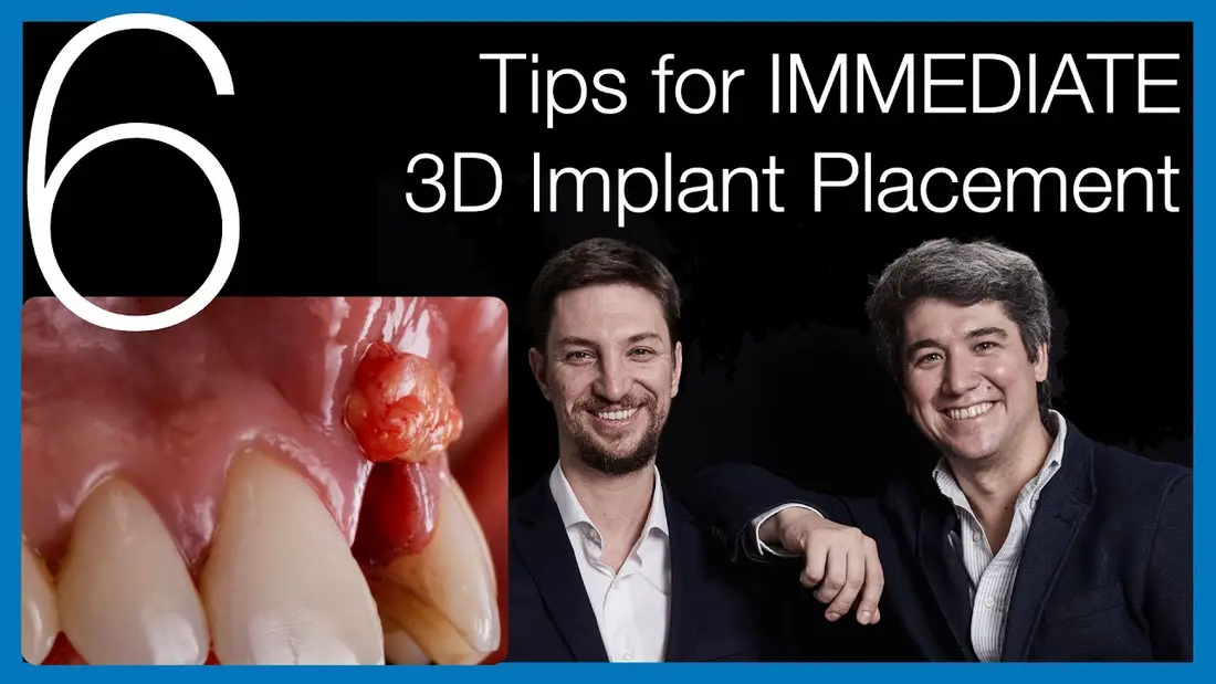 The opening frame of the video: an upper incisor extracted and the implant about to be placed in the socket